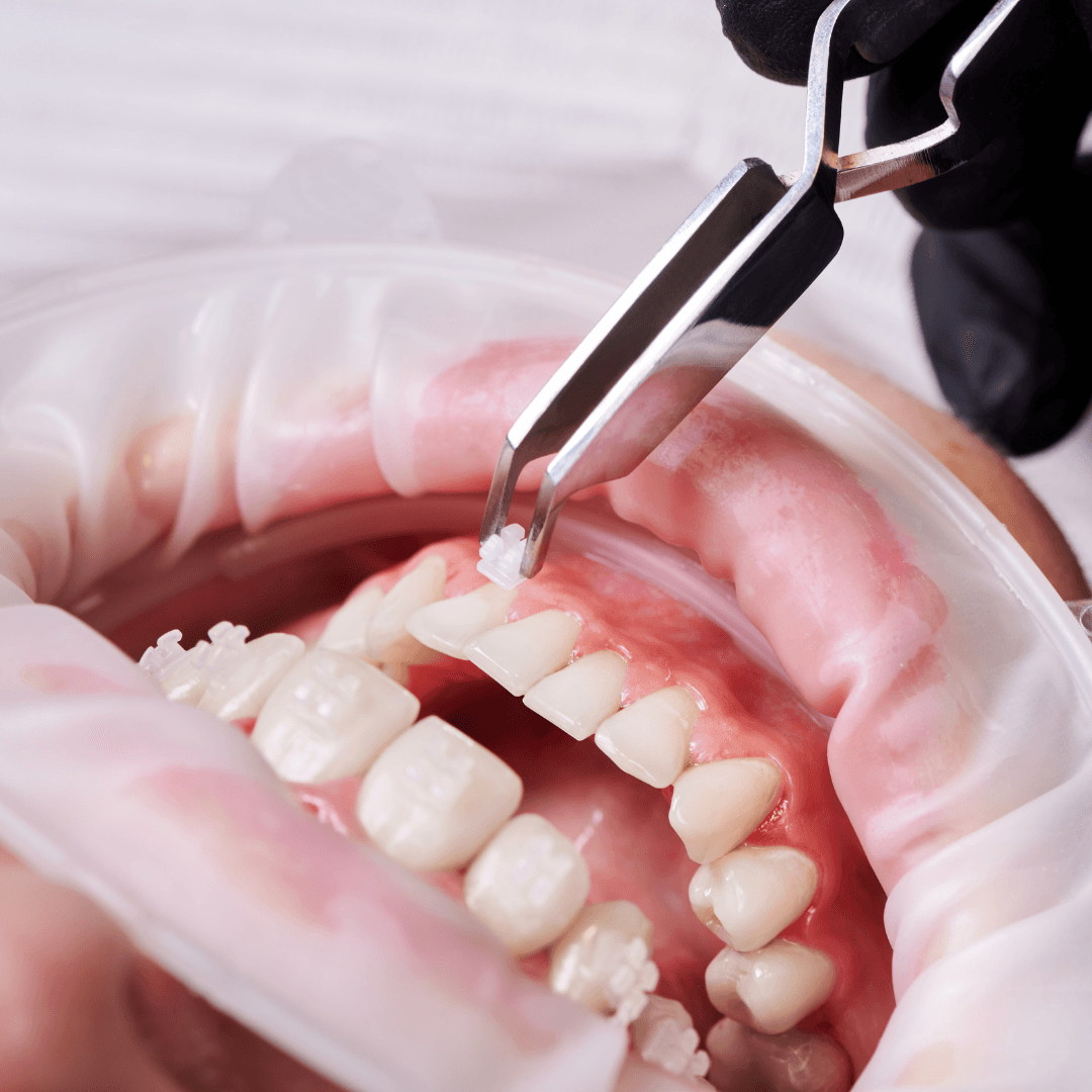 Ortodoncia en pacientes con enfermedad periodontal, Revisión bibliográfica