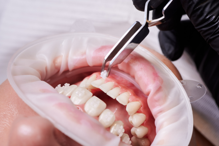 Ortodoncia Universidad Hemisferios Ortodoncia En Pacientes Con Enfermedad Periodontal Revisión Bibliográfica Universidad Hemisferios Ortodoncia Universidad Hemisferios