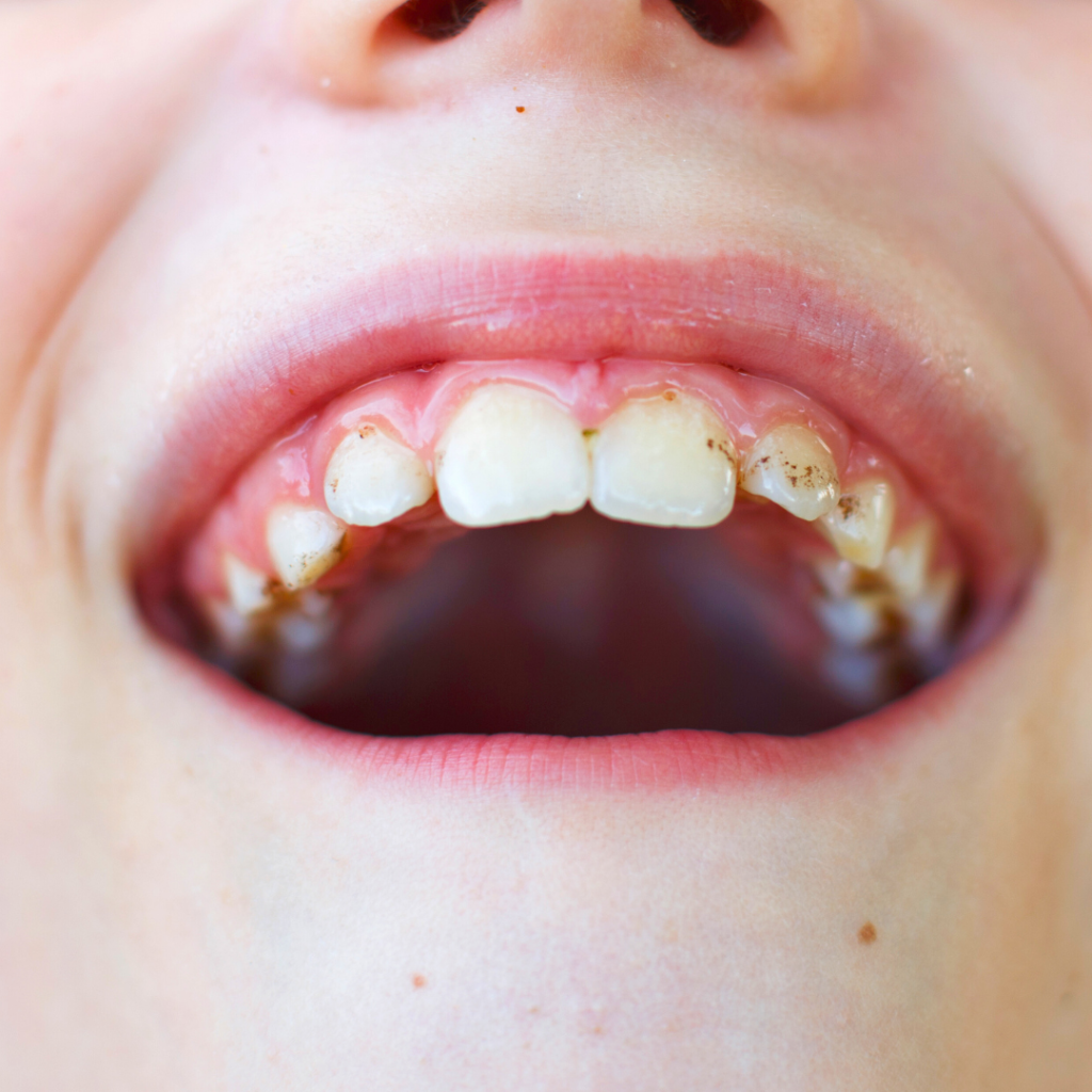 Relación de la presencia de caries dental y placa bacteriana en niños con la situación socioeconómica y cultural de sus familias